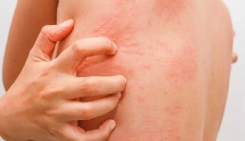 Kaşıntı ve Döküntü Varsa Dikkat!