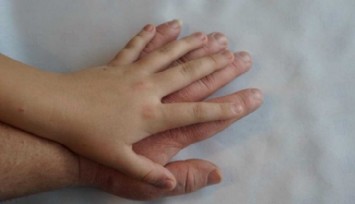 Büyüme Hastalığı(Akromegali) Nedir?