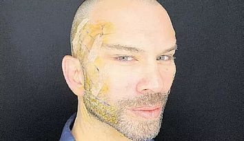 Berksanın Yüzünü Göstermemesinin Sebebi Ortaya Çıktı!